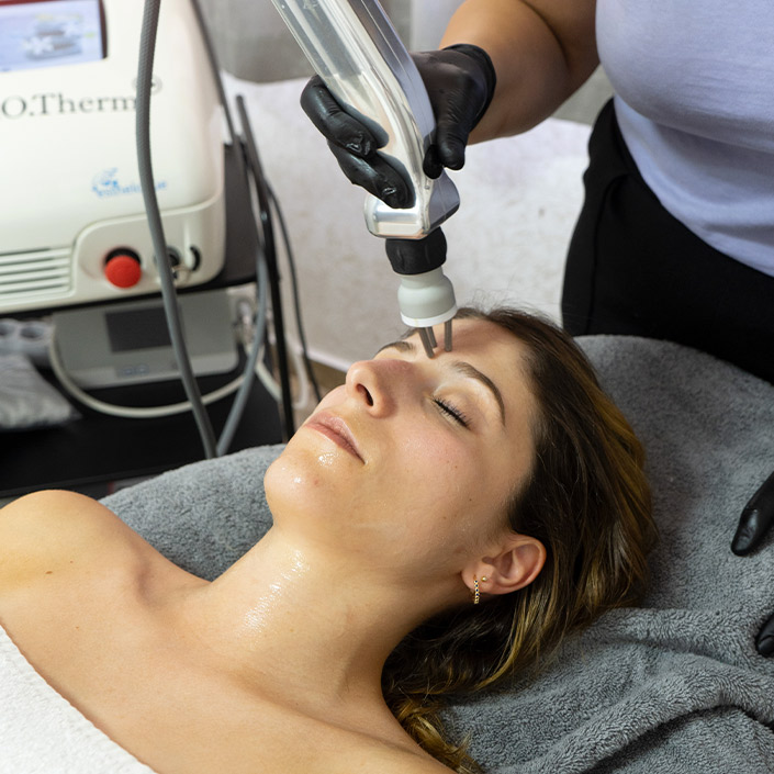 trattamento con dermapen | Beauty Fashion